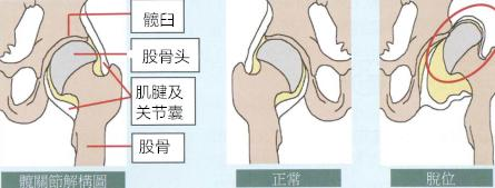 股骨头坏死