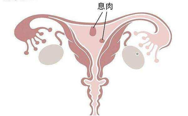 子宫息肉
