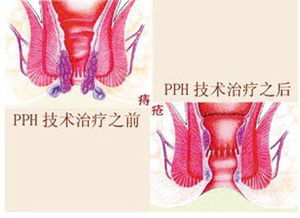 痔疮怎么治?