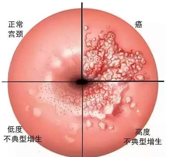 宫颈糜烂