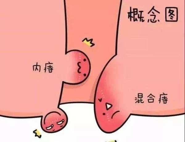 混合痔
