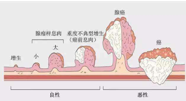 胃息肉如何治疗?