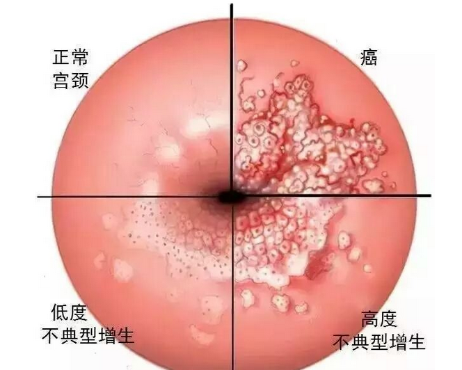 三度宫颈糜烂有什么症状