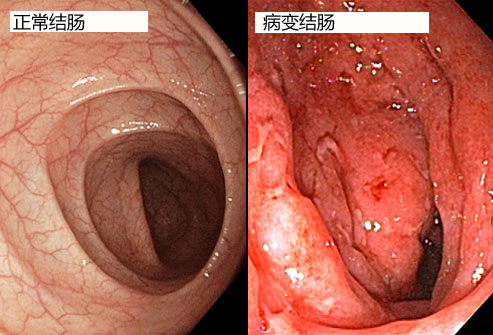 溃疡性结肠炎症状表现
