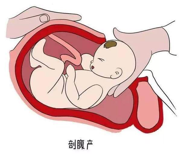 剖腹产多久可以再孕
