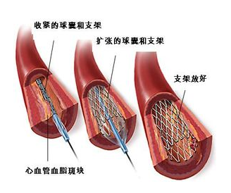 放了心脏支架会影响寿命吗?