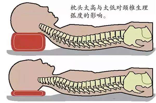 如何给颈椎病患者选择一个合适的枕头?