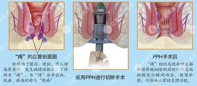 得了痔疮能彻底治愈吗